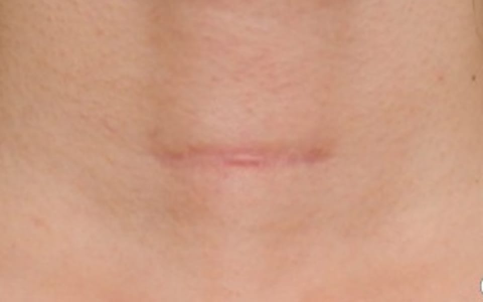 scar-treatment-before-after