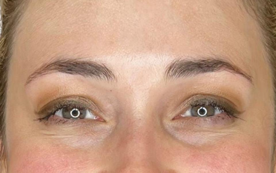 botox-treatment-after