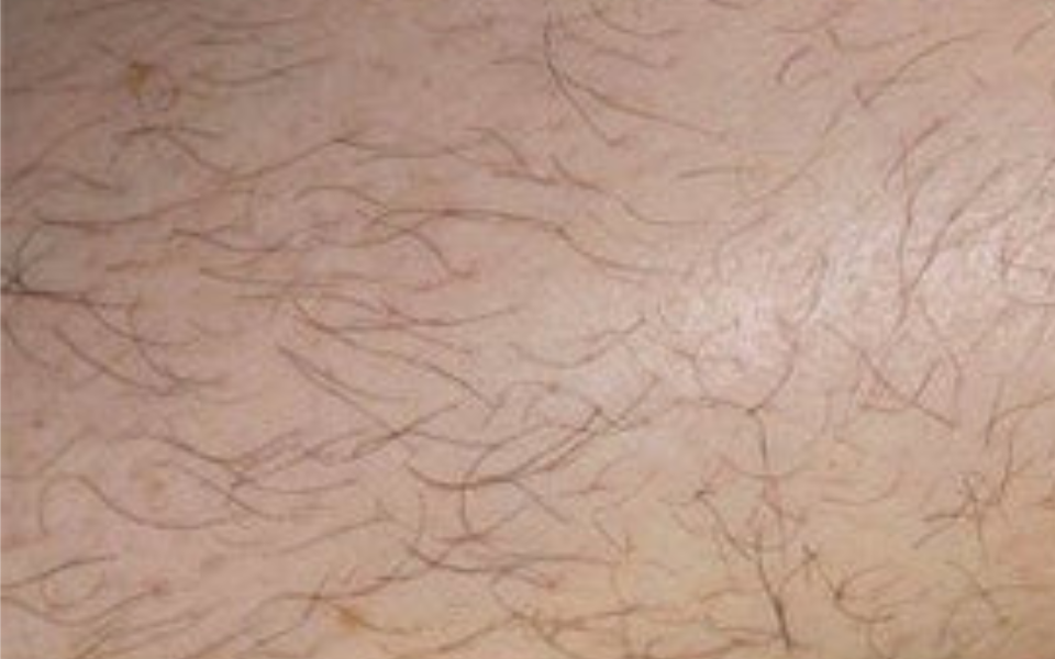 laser-hair-removal-before-after
