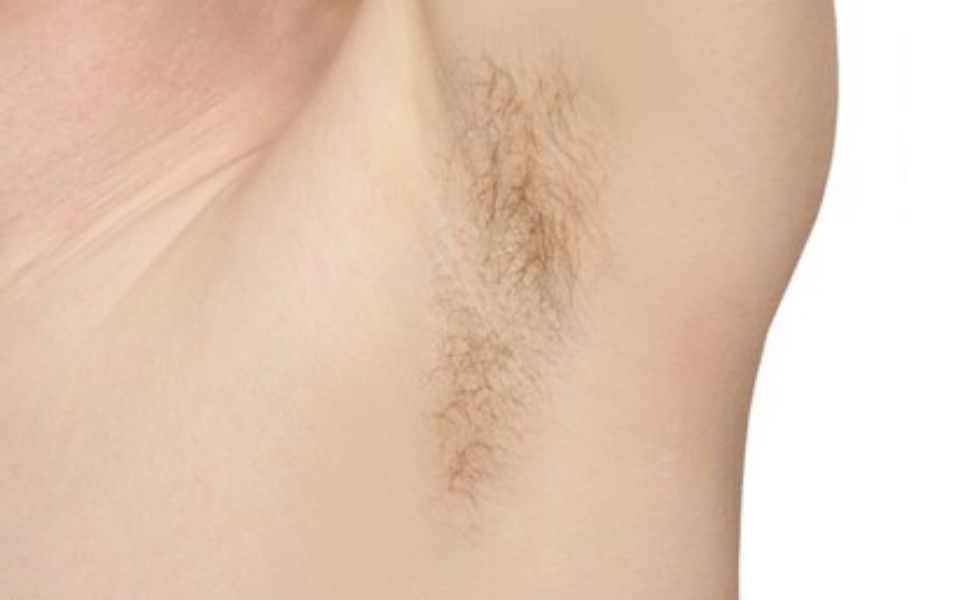 laser-hair-removal-before